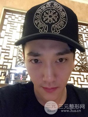 深圳南西子袁新平醫(yī)生給我做的祛眼袋手術，真實案例以及前后對比照片分享