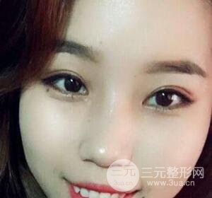 切開雙眼皮無疤痕增生果圖案例