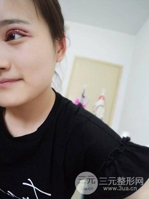 雙眼皮多項整形整形案例以及前后對比圖分享——濟南愛容路傳燕醫(yī)生做的~