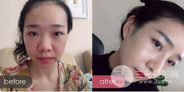 隆鼻整形價(jià)格和真人案例