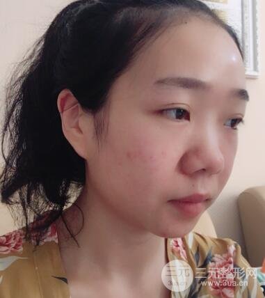 隆鼻整形價(jià)格和真人案例