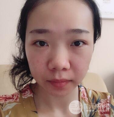 隆鼻整形價(jià)格和真人案例