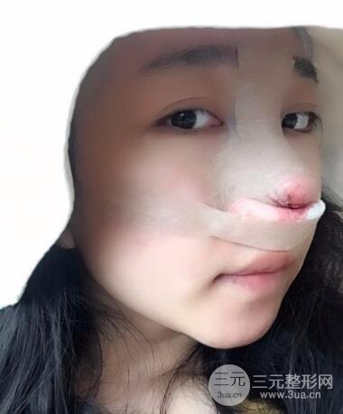 隆鼻整形價(jià)格和真人案例