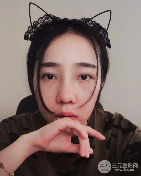 隆鼻整形價(jià)格和真人案例