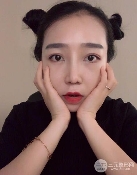 隆鼻整形價(jià)格和真人案例