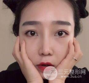 隆鼻整形價(jià)格和真人案例