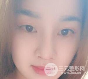 蒜頭鼻整形價(jià)格和對(duì)比照片案例