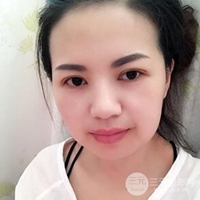 濟南海峽謝燕燕做的雙眼皮多項整形整形手術(shù)，分享一下前后對比圖