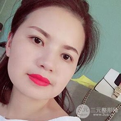 濟南海峽謝燕燕做的雙眼皮多項整形整形手術(shù)，分享一下前后對比圖