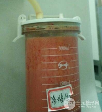 大腿環(huán)吸抽脂價(jià)格和圖片案例