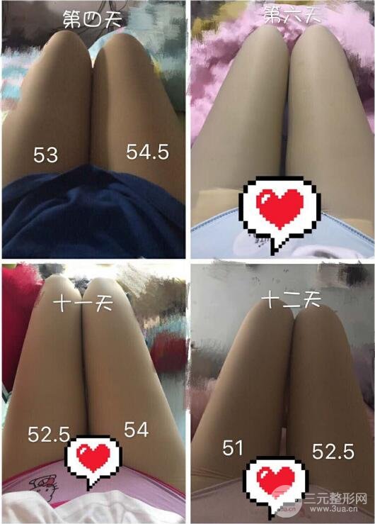 大腿環(huán)吸抽脂價(jià)格和圖片案例