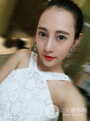 隆鼻失敗修復(fù)手術(shù)真實(shí)案例以及前后對(duì)比圖——青?？等A馮相周醫(yī)生做的