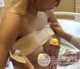 深圳蘭喬醫(yī)院假體隆胸和副乳切除圖片案例