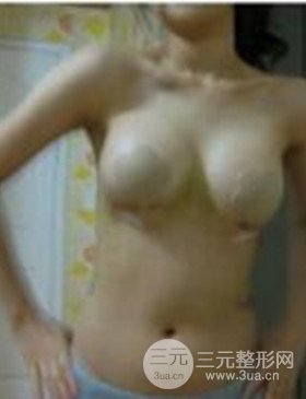 濰坊華美任傳琦給我做的假體隆胸手術(shù)，給大家分享一下前后照片
