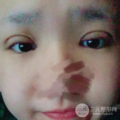 汕頭愛(ài)麗諾蘇國(guó)藝給我做的雙眼皮手術(shù)，把前后的對(duì)比圖片分享給大家