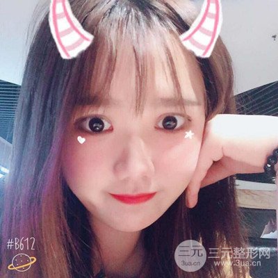 汕頭愛(ài)麗諾蘇國(guó)藝給我做的雙眼皮手術(shù)，把前后的對(duì)比圖片分享給大家