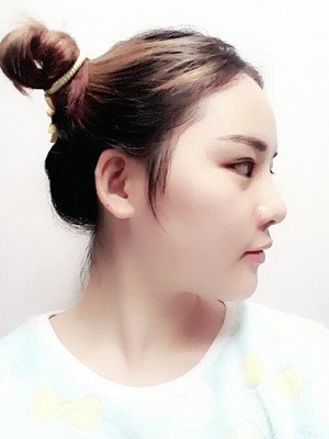 硅膠假體墊下巴真實(shí)案例，汕頭愛(ài)麗諾蘇國(guó)藝做的