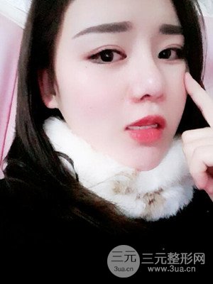 硅膠假體墊下巴真實(shí)案例，汕頭愛(ài)麗諾蘇國(guó)藝做的