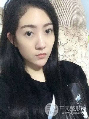 雙眼皮修復(fù)+開內(nèi)眼角真實案例附上前后對比圖片——汕頭伊麗莎白張紅軍做的
