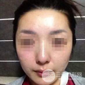 汕頭伊麗莎白張紅軍給我打的B****，分享一下前后照片