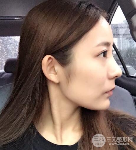 注射玻尿酸注射除皺緊致肌膚前后對(duì)比圖案例