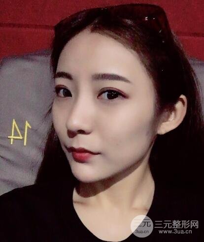 注射玻尿酸注射除皺緊致肌膚前后對(duì)比圖案例