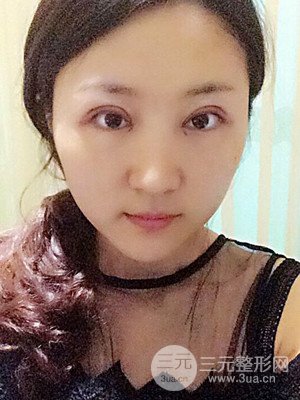 汕頭伊麗莎白孫杰醫(yī)生給我做的切開雙眼皮手術(shù)，分享一下前后對比圖片