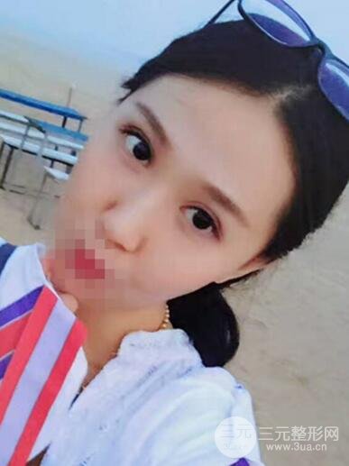 切開雙眼皮無疤痕增生果好圖片案例分享