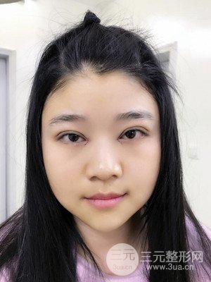 切開雙眼皮+開內(nèi)眼角真實案例，并附上前后對比圖片