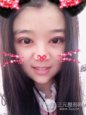 切開雙眼皮+開內(nèi)眼角真實案例，并附上前后對比圖片