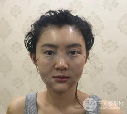 脂肪填充全臉恢復(fù)過程圖
