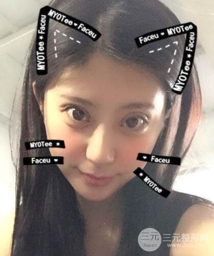 成都嬌點李競割雙眼皮價格和案例