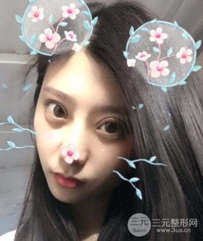 成都嬌點李競割雙眼皮價格和案例