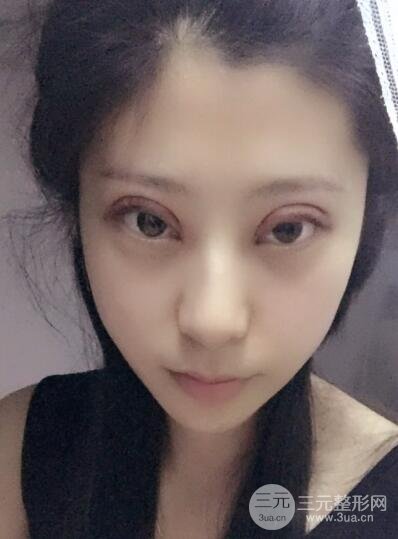 成都嬌點李競割雙眼皮價格和案例