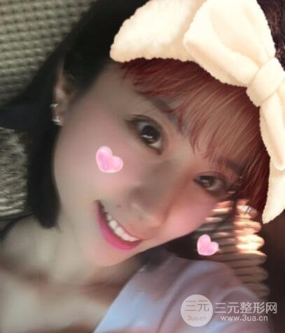 成都嬌點李競割雙眼皮價格和案例