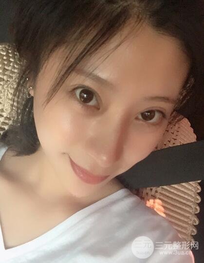 成都嬌點李競割雙眼皮價格和案例