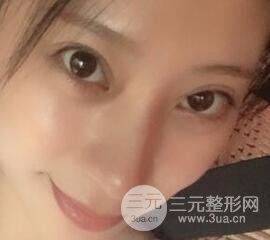 成都嬌點(diǎn)李競(jìng)割雙眼皮價(jià)格和案例