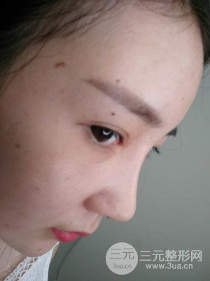 隆鼻整形案例日記分享：附上前后對(duì)比圖片