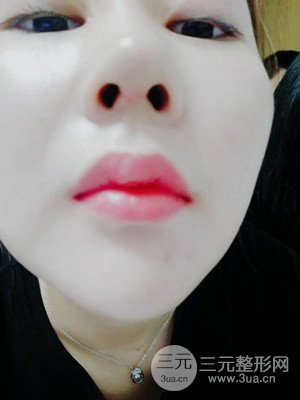 隆鼻整形案例日記分享：附上前后對(duì)比圖片