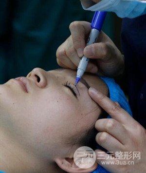 武漢葉子葉飛醫(yī)生給我做的切開雙眼皮手術(shù)，分享一下前后對比圖