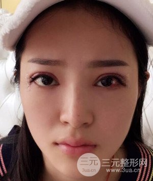 武漢葉子葉飛醫(yī)生給我做的切開雙眼皮手術(shù)，分享一下前后對比圖