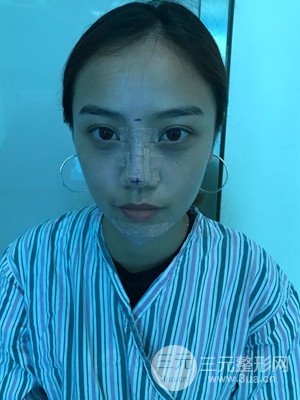 假體隆鼻+耳軟骨墊鼻尖真實案例，并附上前后對比圖~
