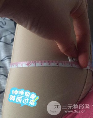 大腿吸脂前后對(duì)比圖以及恢復(fù)過(guò)程分享——武漢葉子竺湘云醫(yī)生做的