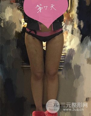 大腿吸脂前后對(duì)比圖以及恢復(fù)過(guò)程分享——武漢葉子竺湘云醫(yī)生做的