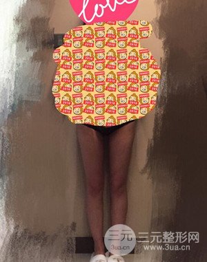 大腿吸脂前后對(duì)比圖以及恢復(fù)過(guò)程分享——武漢葉子竺湘云醫(yī)生做的