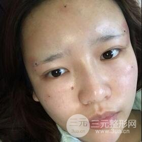 成都嬌點(diǎn)整容醫(yī)院李競(jìng)做全臉脂肪填充案例