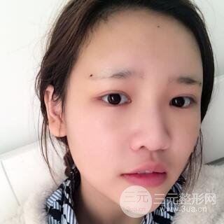 成都嬌點(diǎn)整容醫(yī)院李競(jìng)做全臉脂肪填充案例