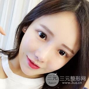 成都嬌點(diǎn)整容醫(yī)院李競(jìng)做全臉脂肪填充案例
