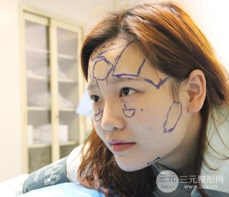 成都嬌點(diǎn)整容醫(yī)院李競(jìng)做全臉脂肪填充案例