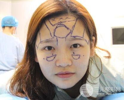 成都嬌點(diǎn)整容醫(yī)院李競(jìng)做全臉脂肪填充案例